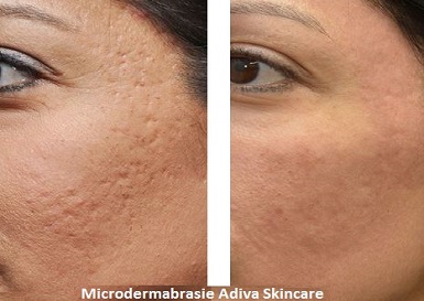 huidverbetering Breukelen schoonheidssalon Adiva Skincare