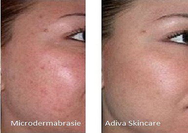 microdermabrasie Breukelen schoonheidssalon Adiva Skincare