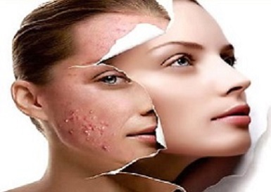 huidverbetering Breukelen schoonheidssalon Adiva Skincare